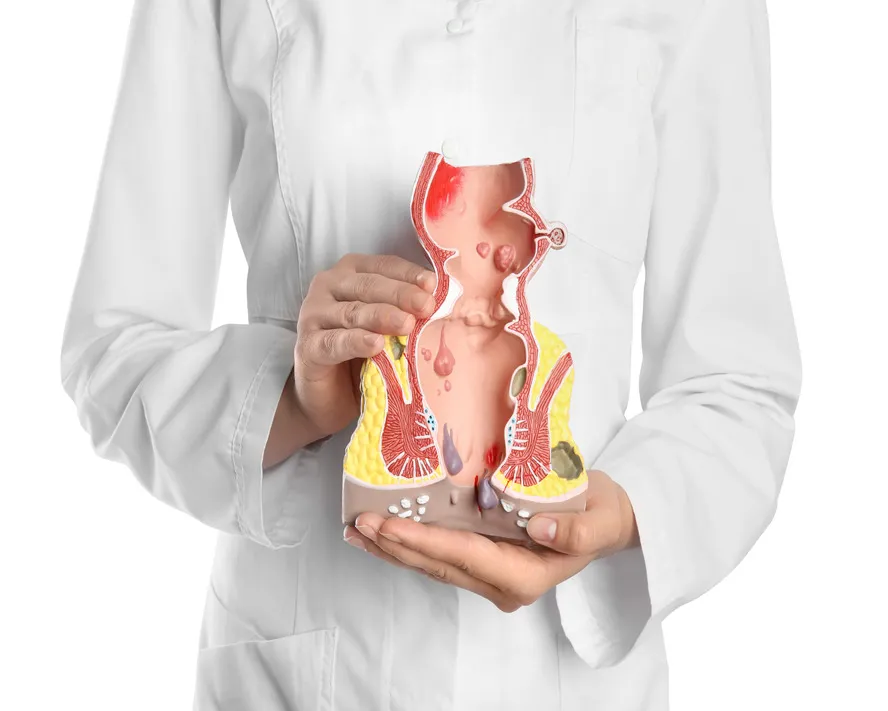 Anal Apse ve Anal Fistül