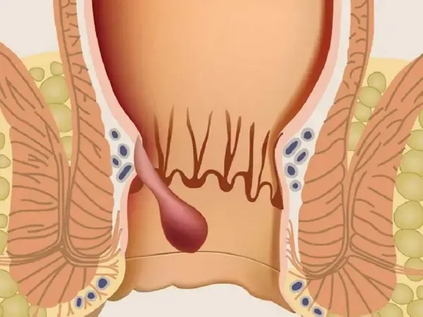 Hemoroidal Hastalık
