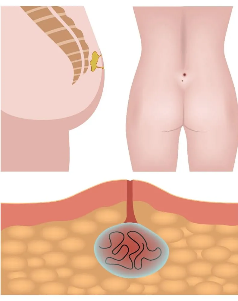 Pilonidal Hastalık
