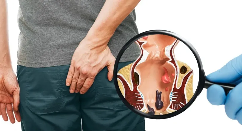 Hemoroid hastalığı nedir?